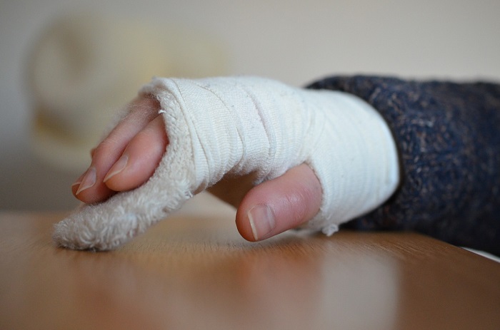 Bei sehnenscheidenentzündung gips Wie kann