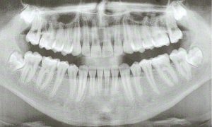 Präpoperatives Röntgenbild mit verlagertem Zahn 48