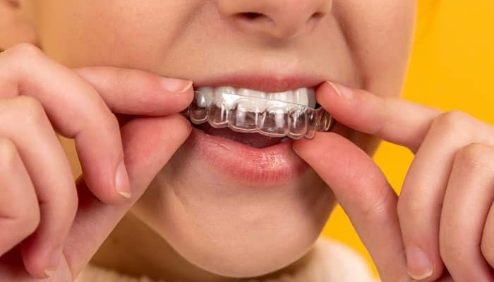 Eine Jugendliche legt Ihre durchsichtige Zahnspange (Invisalign) an