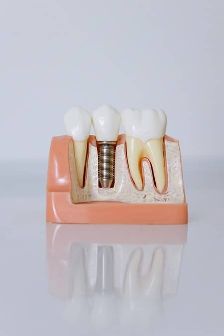 Ein Zahnmodell auf dem ein Zahnimplantat im Querschnitt zu sehen ist