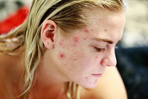 Eine junge Frau, deren Gesicht extrem mit Akne gekennzeichnet ist