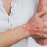 Die häufigsten Hautkrankheiten im Überblick